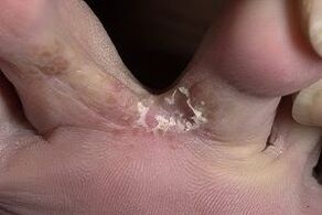 objawy grzybicy na stopach