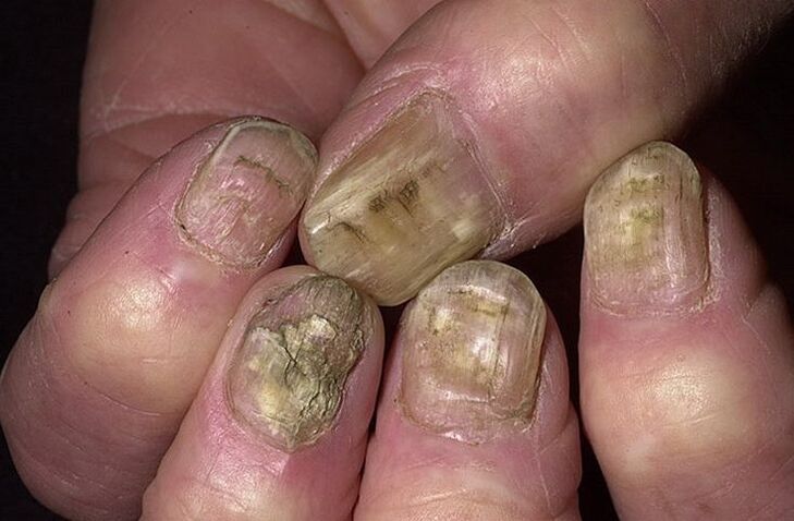 Deformacja, separacja i kruszenie się paznokci na skutek grzybów