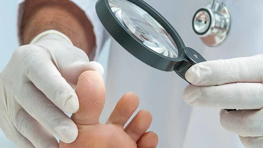 Diagnozę grzybicy paznokci przeprowadza dermatolog