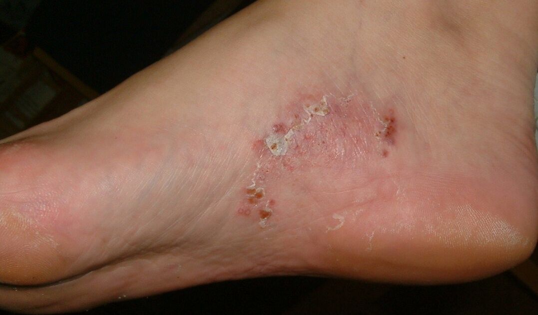 Objawy infekcji grzybiczej na stopie